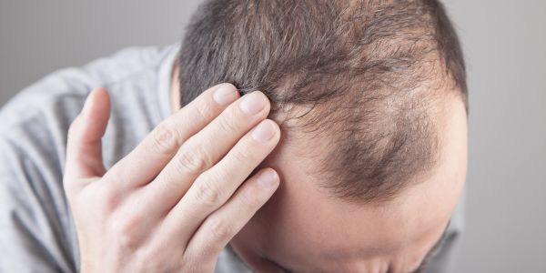 Le meilleur traitement naturel contre l'alopécie : découvrez le pouvoir de guérison 